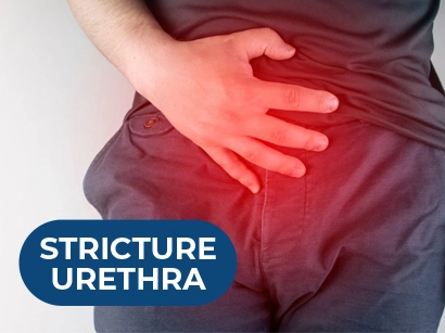 Stricture Urethra